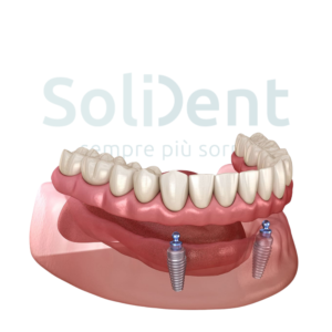Barra avvitata denti in composito su impianti